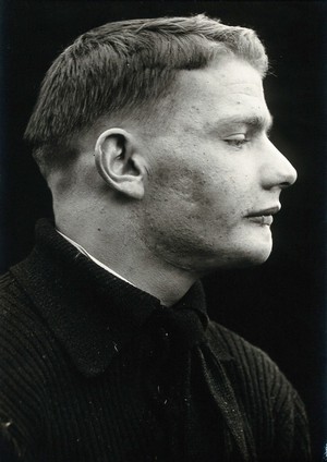 view Cranio-facial injury: a man with a scarred lower lip following plastic surgery: in profile. Photograph, 1912.