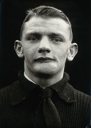 view Cranio-facial injury: a man with a scarred lower lip and chin, following plastic surgery. Photograph, 1912.