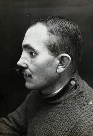 view Cranio-facial injury: a French soldier with scarring due to a skin graft to the bridge of the nose and face surgery: in profile. Photograph, 1916.