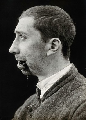 Cranio-facial injury: a French soldier with a wound to the mouth and chin, wearing a metal brace in his mouth, before plastic surgery: in profile. Photograph, 1916.