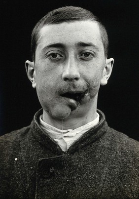 Cranio-facial injury: a French soldier with a wound to the mouth and chin, before plastic surgery. Photograph, 1916.