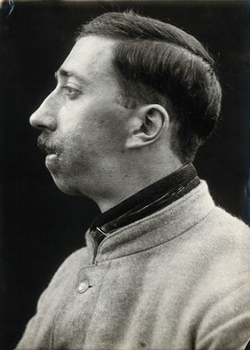 Cranio-facial injury: a French soldier after plastic surgery to the mouth and chin: in profile. Photograph, 1917.