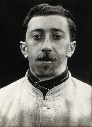 view Cranio-facial injury: a French soldier after plastic surgery to the mouth and chin. Photograph, 1917.