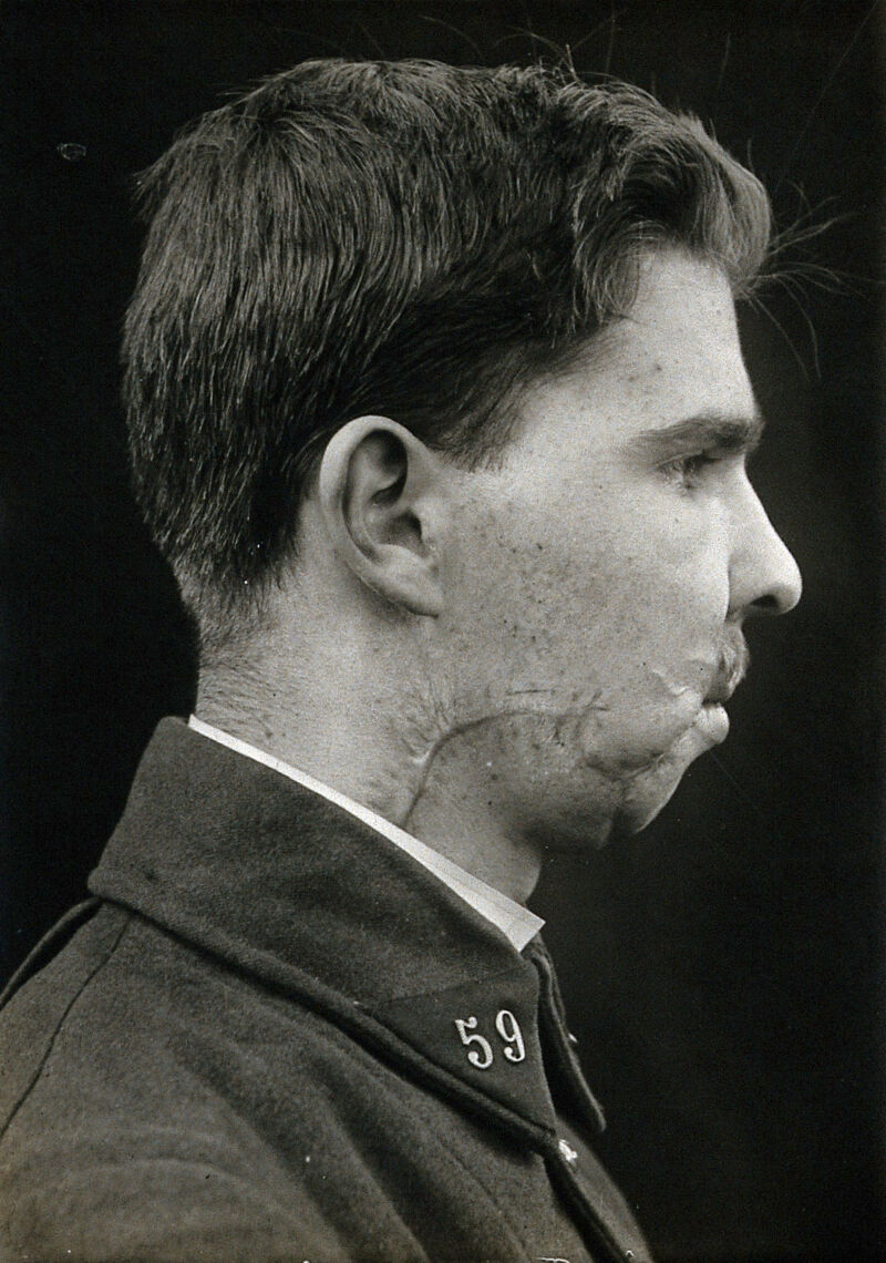 Cranio-facial injury: a French soldier with scarring after plastic ...