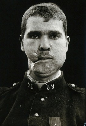 Cranio-facial injury: a French soldier after incomplete plastic surgery to the lower face and neck. Photograph, 1916.