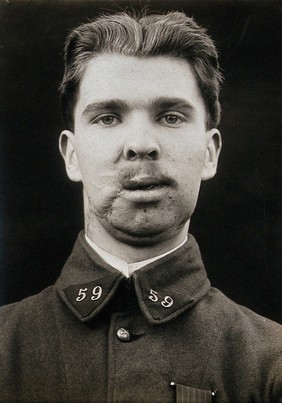 Cranio-facial injury: a French soldier with scarring after plastic surgery to the lower face and neck. Photograph, 1917.