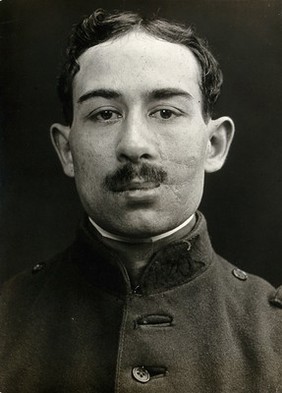 Cranio-facial injury: a French soldier after plastic surgery to a severe wound to his mouth and cheek. Photograph, 1916.