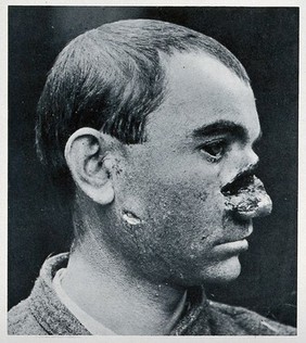 Cranio-facial injury: a man with a severe wound to his nose, before plastic surgery. Reproduction, ca. 1940 (?), of a photograph, ca. 1916.