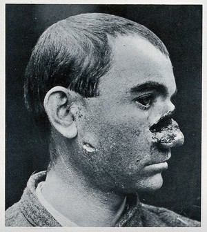 view Cranio-facial injury: a man with a severe wound to his nose, before plastic surgery. Reproduction, ca. 1940 (?), of a photograph, ca. 1916.