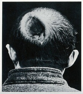 Cranio-facial injury: a large hole in the back of a man's head, before plastic surgery. Reproduction, ca. 1940 (?), of a photograph, ca. 1916.