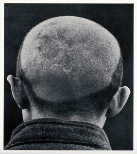 Cranio-facial injury: the back of a man's shaved head following plastic surgery, showing scarring. Reproduction, ca. 1940 (?), of a photograph, ca. 1916.