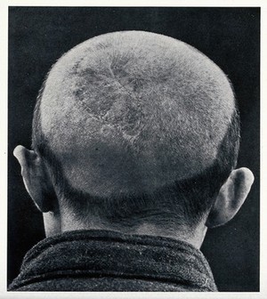 view Cranio-facial injury: the back of a man's shaved head following plastic surgery, showing scarring. Reproduction, ca. 1940 (?), of a photograph, ca. 1916.