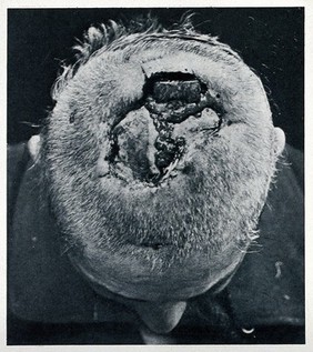 Cranio-facial injury: a large wound at the top of a man's head, before plastic surgery. Reproduction, ca. 1940 (?), of a photograph, ca. 1916.