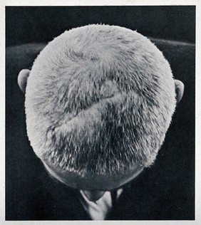Cranio-facial injury: the top of a man's head showing scarring, following plastic surgery. Reproduction, ca. 1940 (?), of a photograph, ca. 1916.