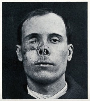 view Cranio-facial injury: a man with a wounded and discoloured nose and eye area, before plastic surgery. Reproduction, ca. 1940 (?), of a photograph, ca. 1916.