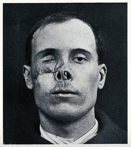 Cranio-facial injury: a man with a wounded and discoloured nose and eye area, before plastic surgery. Reproduction, ca. 1940 (?), of a photograph, ca. 1916.