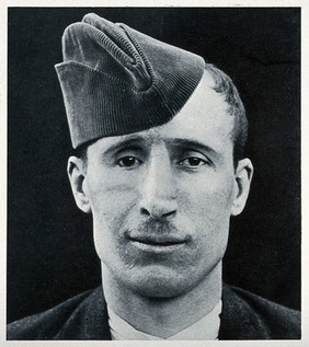 Cranio-facial injury: a man in a cap, following plastic surgery to his nose and eye area. Reproduction, ca. 1940 (?), of a photograph, ca. 1916.
