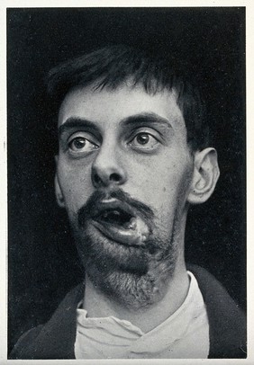 Cranio-facial injury: a man with a wounded mouth and swelling to the chin and neck, before plastic surgery. Reproduction, ca. 1940 (?), of a photograph, ca. 1916.