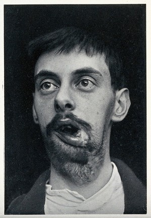 view Cranio-facial injury: a man with a wounded mouth and swelling to the chin and neck, before plastic surgery. Reproduction, ca. 1940 (?), of a photograph, ca. 1916.