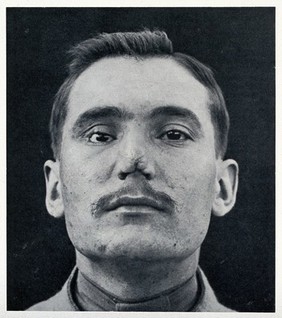 Cranio-facial injury: a man with a mishapen, scarred nose, before plastic surgery. Reproduction, ca. 1940 (?), of a photograph, ca. 1916.