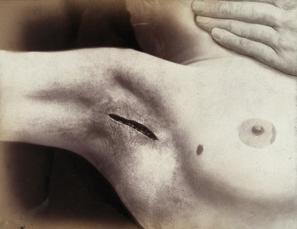 An operation in progress: an incision in the armpit. Photograph by Félix Méheux, ca. 1900.