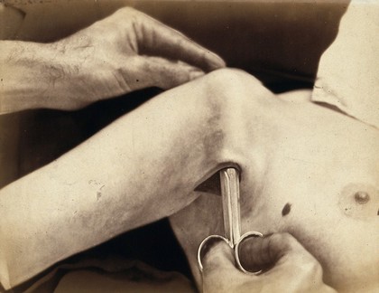 An operation in progress: a metal surgical implement is placed inside an incision in the armpit. Photograph by Félix Méheux, ca. 1900.