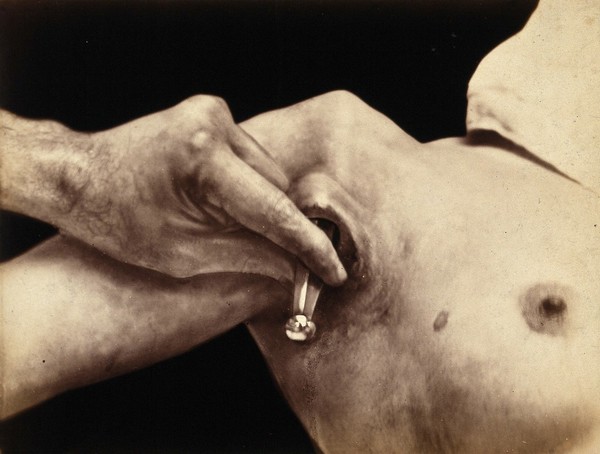 An operation in progress: a metal surgical implement is placed inside an incision in the armpit. Photograph by Félix Méheux, ca. 1900.