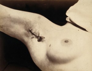 view An operation in progress: a metal clip in an incision in the armpit. Photograph by Félix Méheux, ca. 1900.