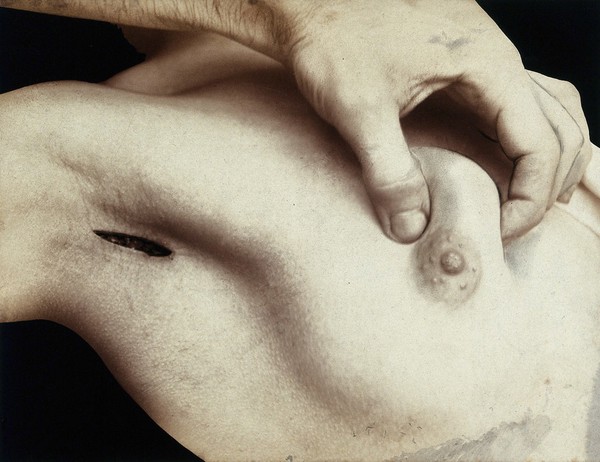 A breast operation to remove a lump, in progress: an incision in the armpit; the breast is pinched between thumb and forefinger. Photograph by Félix Méheux, ca. 1900.