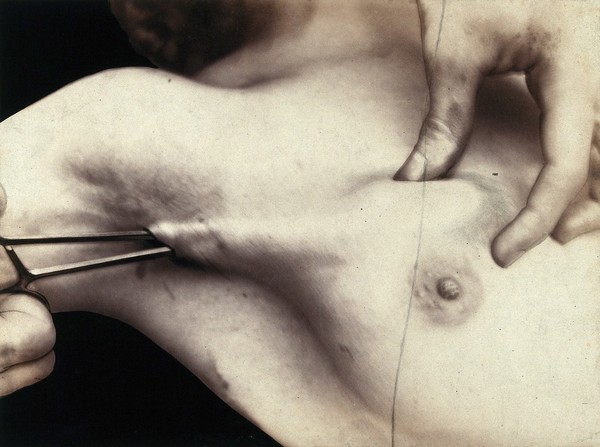 A breast operation to remove a lump, in progress: a metal surgical implement is placed into the breast via an incision in the armpit. Photograph by Félix Méheux, ca. 1900.