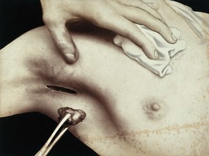 view A breast operation to remove a lump, in progress: metal surgical tongs hold a lump taken from the breast via an incision in the armpit. Photograph by Félix Méheux, ca. 1900.