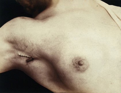 A breast operation to remove a lump, in progress: an incision in the armpit which has been sewn up. Photograph by Félix Méheux, ca. 1900.