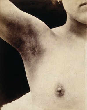 view A breast operation to remove a lump, in progress: scarring to the armpit following the operation. Photograph by Félix Méheux, ca. 1900.