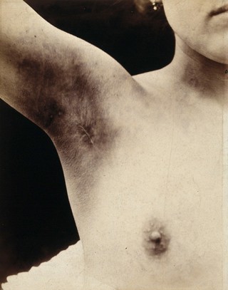 A breast operation to remove a lump, in progress: scarring to the armpit following the operation. Photograph by Félix Méheux, ca. 1900.