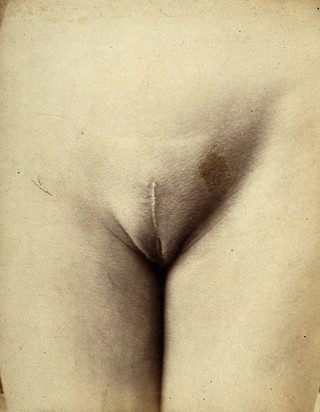 Cosmetic surgery: post-operative stage: a woman's pubes, showing scarring to the mons pubis. Photograph by Félix Méheux, 1903/1905.