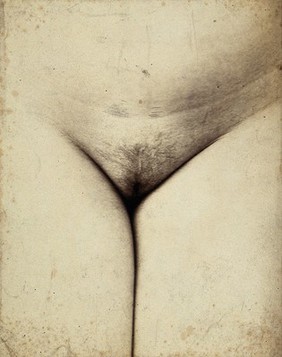 Cosmetic surgery: post-operative stage: a woman's pubes, showing normal hair regrowth and minimal scarring following the operation. Photograph by Félix Méheux, 1903/1905.