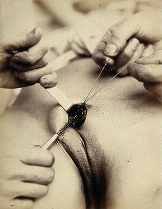 Cosmetic surgery in progress: a woman's pubes, showing metal surgical implements suturing an incision in the mons pubis. Photograph by Félix Méheux, 1903/1905.