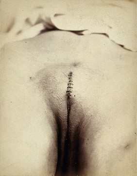 Cosmetic surgery in progress: a woman's pubes, showing a sutured incision in the mons pubis. Photograph by Félix Méheux, 1903/1905.