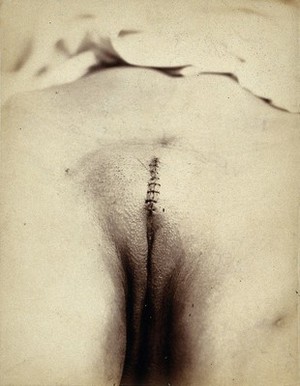 view Cosmetic surgery in progress: a woman's pubes, showing a sutured incision in the mons pubis. Photograph by Félix Méheux, 1903/1905.