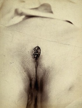 Cosmetic surgery in progress: a woman's pubes with an incision in the mons pubis. Photograph by Félix Méheux, 1903/1905.