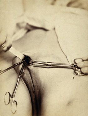 Cosmetic surgery in progress: a woman's pubes showing metal surgical implements at an incision in the mons pubis. Photograph by Félix Méheux, 1903/1905.