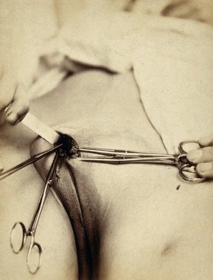 view Cosmetic surgery in progress: a woman's pubes showing metal surgical implements at an incision in the mons pubis. Photograph by Félix Méheux, 1903/1905.