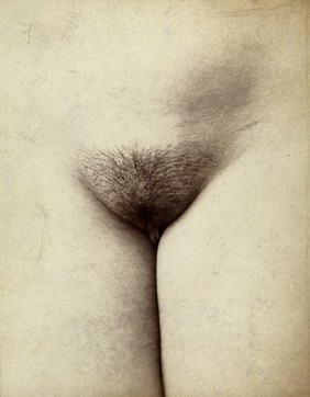 Cosmetic surgery: pre-operative stage: a woman's pubes with labia minora slightly protruding. Photograph by Félix Méheux, 1903/1905.