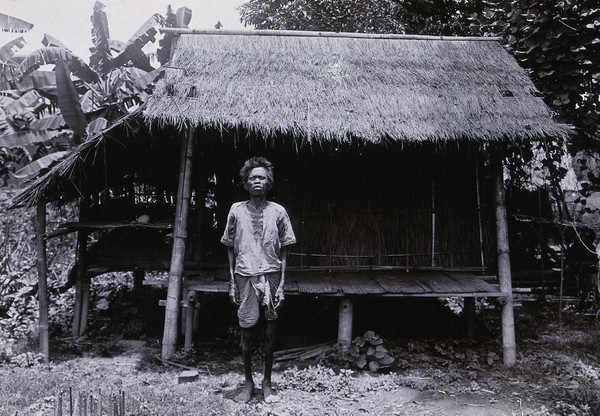 Chiengmai Leper Asylum, Thailand: a male patient outside a basic grass-roofed shelter. Photograph, 1921.