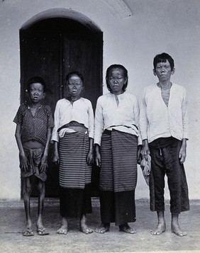 Chiengmai Leper Asylum, Thailand: a family (father and three children) all suffering from leprosy. Photograph, 1921.