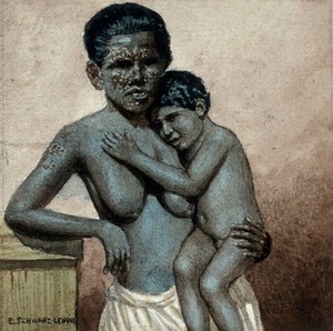 view Leprosy: a mother with leprosy (bare-chested) holds her naked child. Watercolour by E. Schwarz Lenoir, 1920/1950 (?).