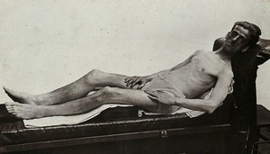 view A diabetic man after treatment with insulin. Photograph, ca. 1925.