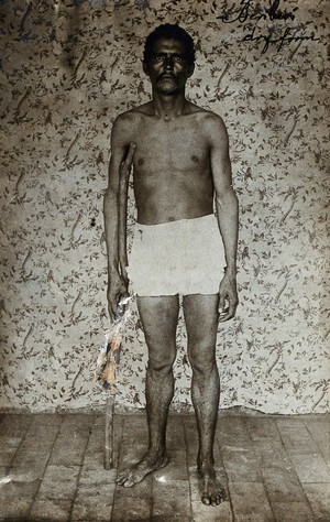 view A man suffering from dry beri-beri standing bare-chested, holding a walking stick. Photograph, 1910/1920.