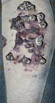 A diseased limb: open, infected sores caused by a deficiency disease. Watercolour, 1900/1950.