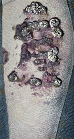 view A diseased limb: open, infected sores caused by a deficiency disease. Watercolour, 1900/1950.